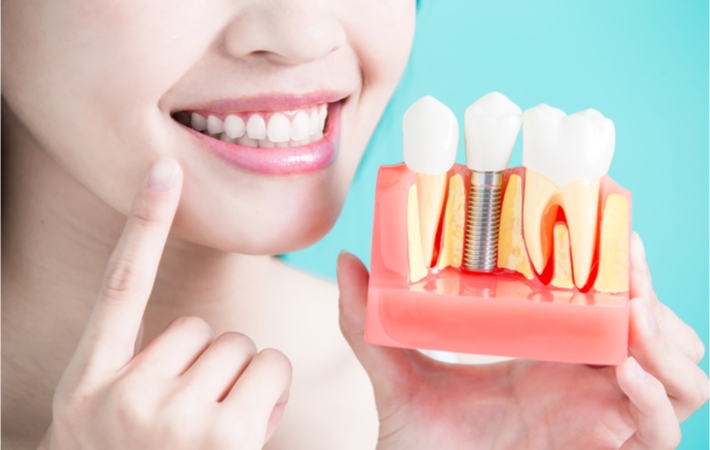 A young woman smiling and pointing at her perfect smile with her right hand while she holds a cross section model of na implanted tooth with her left hand.