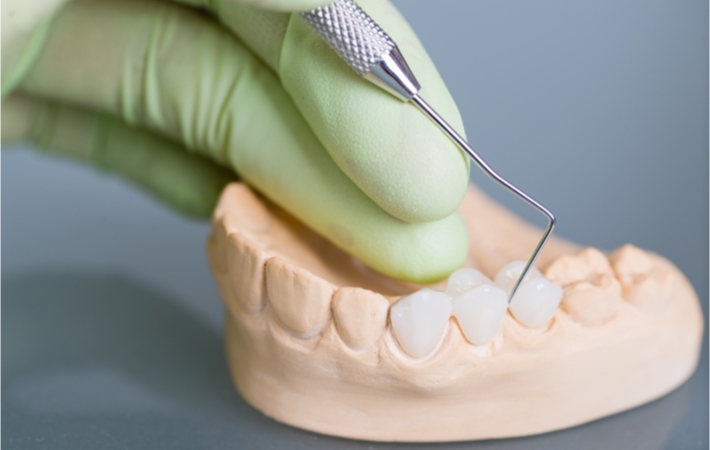 Image of a hand wearing a green protective glove examining a dental bridge on a gypsum model with a dental explorer.