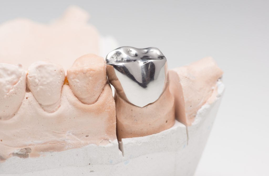 Close up image of a dental cast showing a metal crown installed on a tooth.