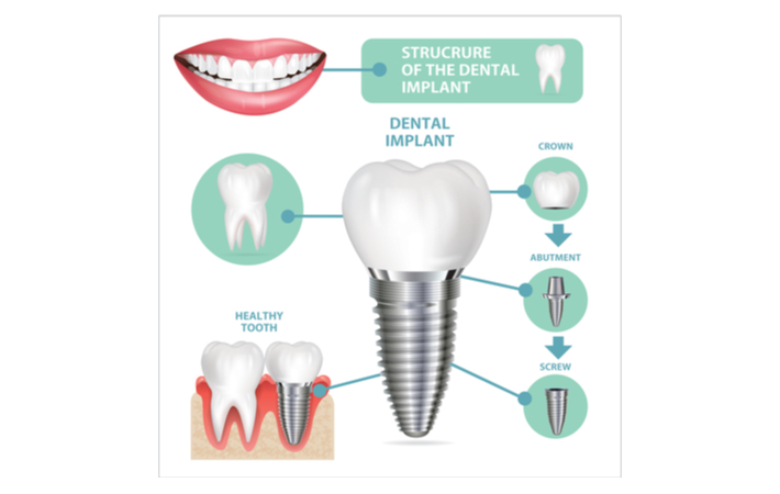 Graphical representation of the components of a dental implant. A dental implant is shown in the center, while the crown, abutment, and screw components are shown separate to the right of it.