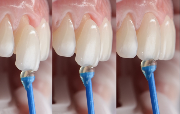 Three up close images of the process of attaching a veneer. Showing bringing the veneer to the tooth, lining it up with the teeth, and finally placing onto the tooth.